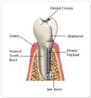 Colorado Springs dental implants
