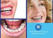 How Do Braces Work To Straighten Your Teeth?